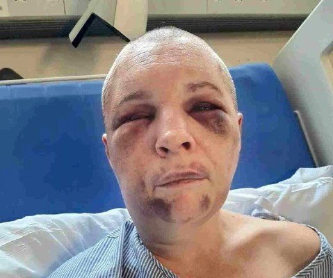 Tommy Hitt's victim. Photo released June 16 2025. A man from Sutton Veny has been sentenced to 21.5 years in prison for multiple domestic abuse offences, putting a victim through a 10-hour torture. Tommy Hitt, 46, of Springhead, was sentenced to 21 years and six months in prison. He was also ordered to pay a surcharge of ?228 and was made the subject of a restraining order. On February 21, Hitt subjected his victim to a 10-hour ordeal, kept her at his property against her will, assaulted her numerous times and shaved her head. Hitt caused many long-lasting physical and psychological injuries including causing damage to her face, permanent damage to her eyes, teeth and arm.