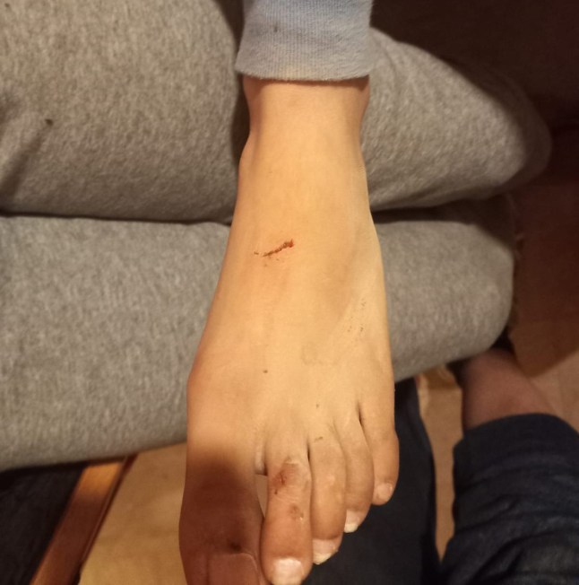 Cut on Sanjay's daughter foot.