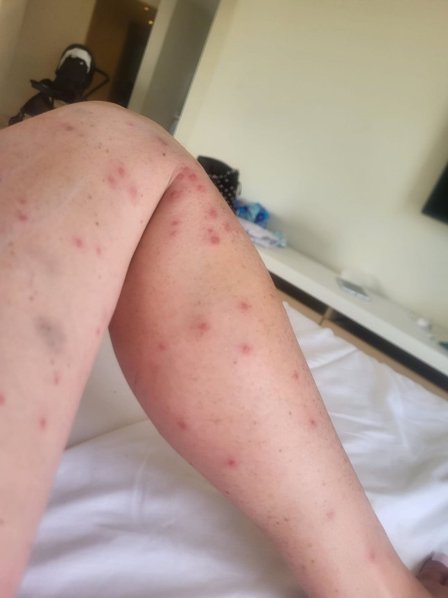 PIC FROM Kennedy News and Media (PICTURED: 42-YEAR-OLD EMMA HICKEY'S MOSQUITO BITES) A mum is fighting for her life after plummeting down hotel stairs and hitting her head - as an infection from MOSQUITO BITES made her faint. Emma Hickey and her partner Stephen Brougham took their two kids to Costa Adeje, Tenerife, Spain, on June 13th for a sun-soaked 12-day getaway. Just 11 days into the trip, the mum-of-two woke up with a 'really bad case' of mosquito bites so went to hospital and was prescribed injections. DISCLAIMER: While Kennedy News and Media uses its best endeavours to establish the copyright and authenticity of all pictures supplied, it accepts no liability for any damage, loss or legal action caused by the use of images supplied and the publication of images is solely at your discretion. SEE KENNEDY NEWS COPY - 0161 697 4266