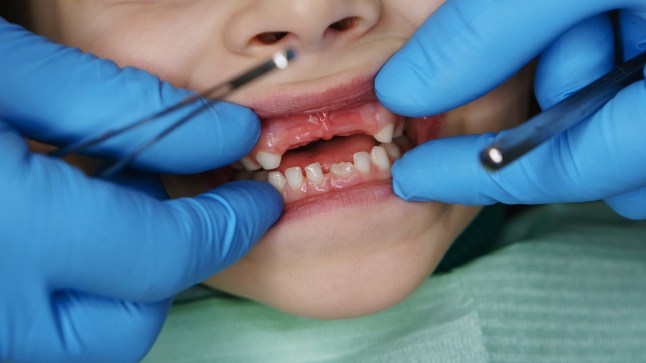 Little girl on examination at dentist. She opened her mouth wide. Dentist examines milk teeth and gums. Four upper teeth are missing from girl. Close-ups