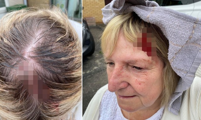 Seagull ‘whacks’ into woman leaving her with bloody head wound post thumbnail image
