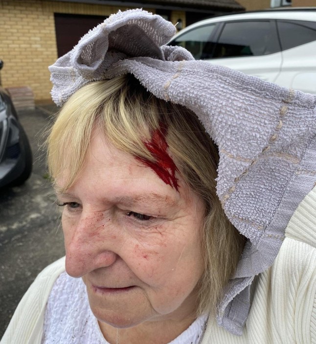 Lesley Wright, after she was attacked by a seagull. A woman was rushed to hospital with a head wound after she was attacked - by a seagull. Lesley Wright, 70, was left with a bleeding scalp that required medical attention after the unprovoked attack by the bird. She was walking to a neighbour's house in Moray in Scotland when the gull swooped in from behind and hit her in the back of the head, leaving her dazed and in pain. Lesley was left with a scar and a bald patch - and is questioning why seagulls are a protected species. Photo released 17/08/2025